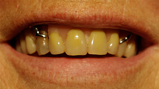 Delprotese med stålbøjler